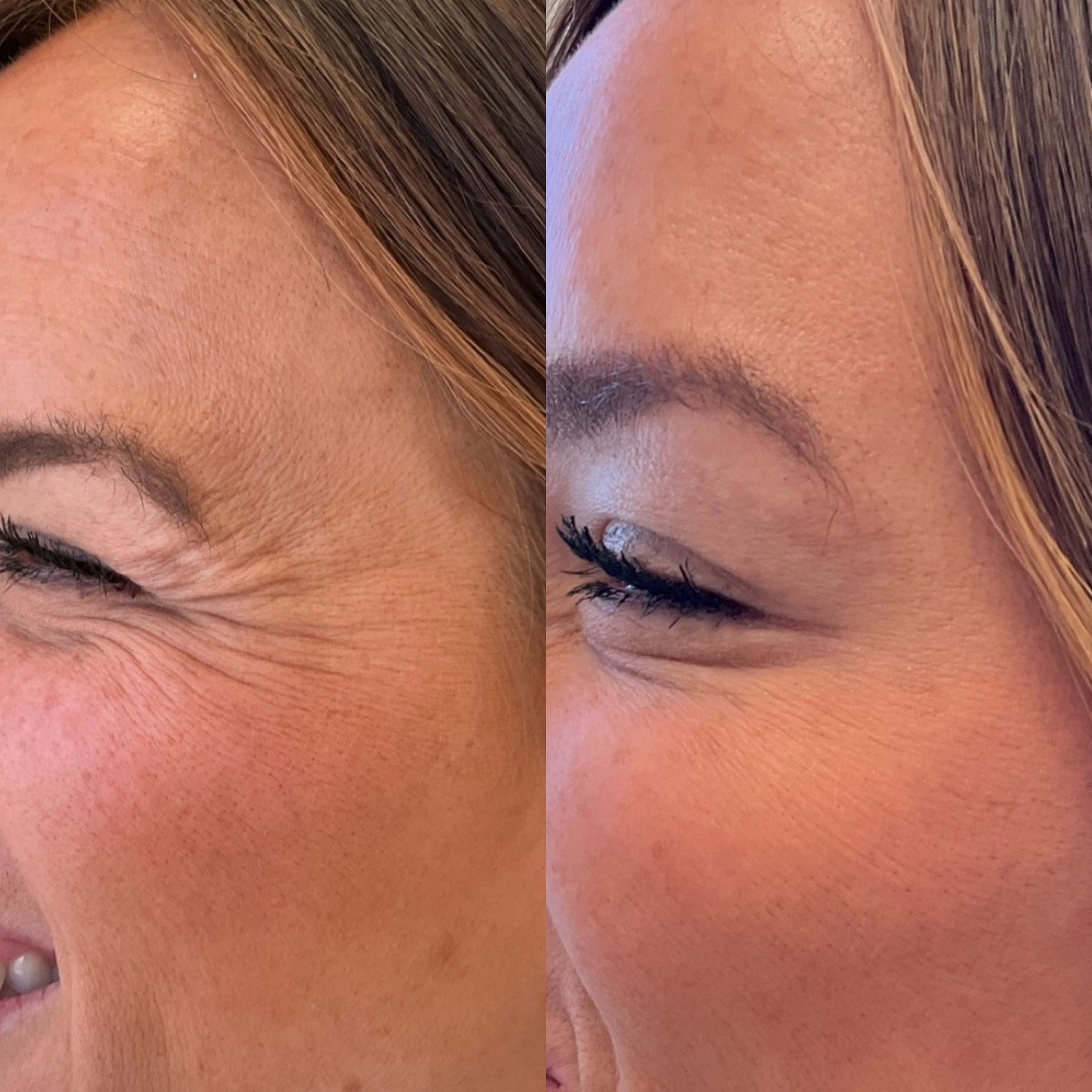 A before and after photo of a woman 's forehead wrinkles.