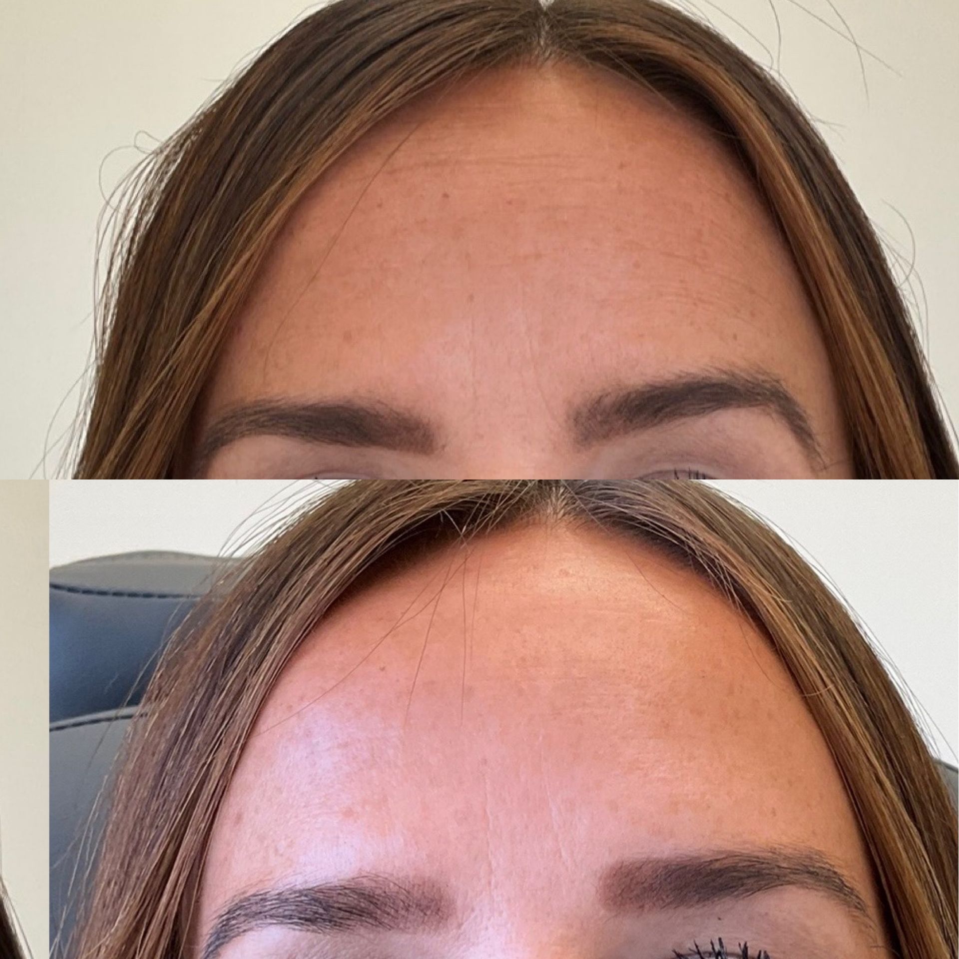 A before and after picture of a woman 's forehead.