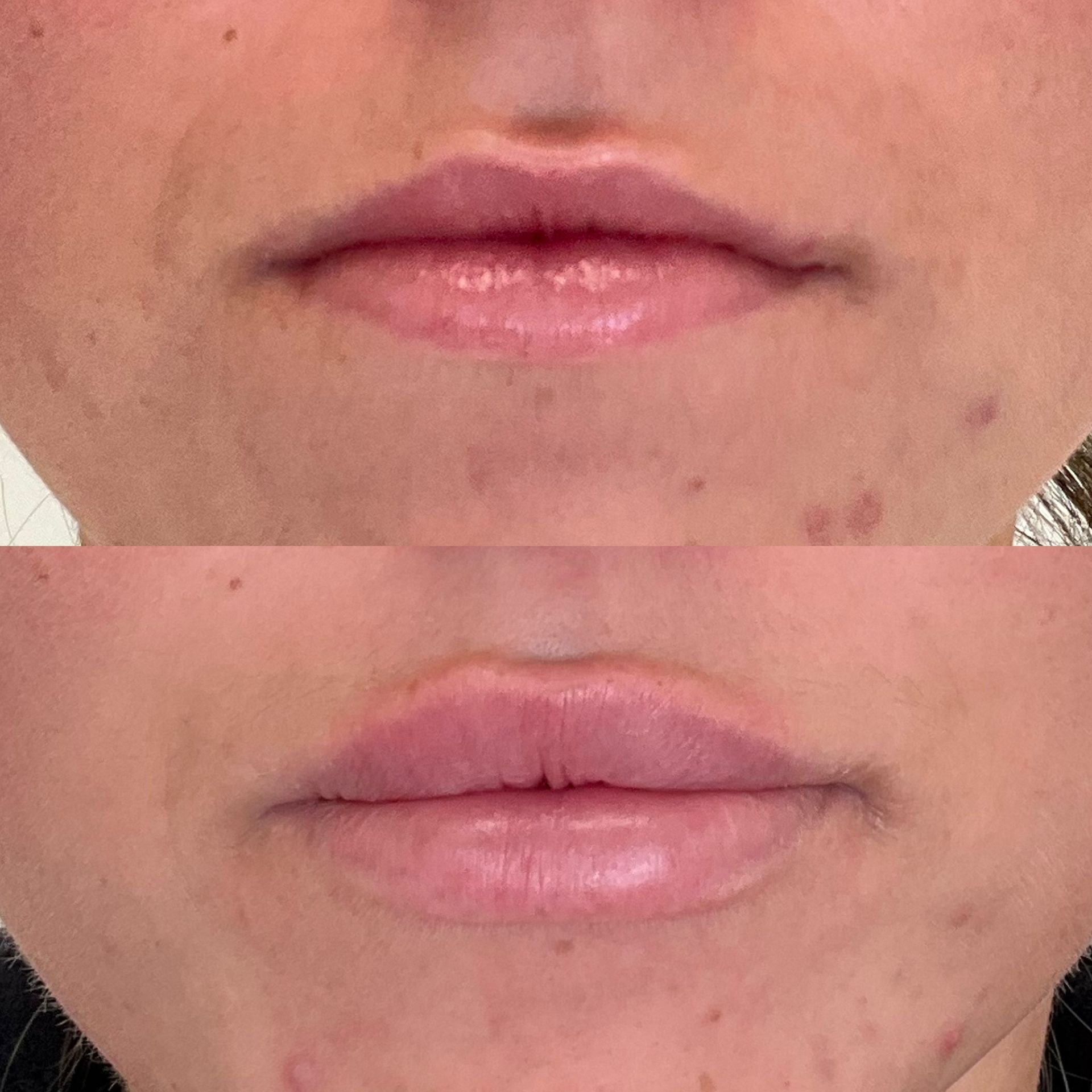 A before and after photo of a woman 's lips.