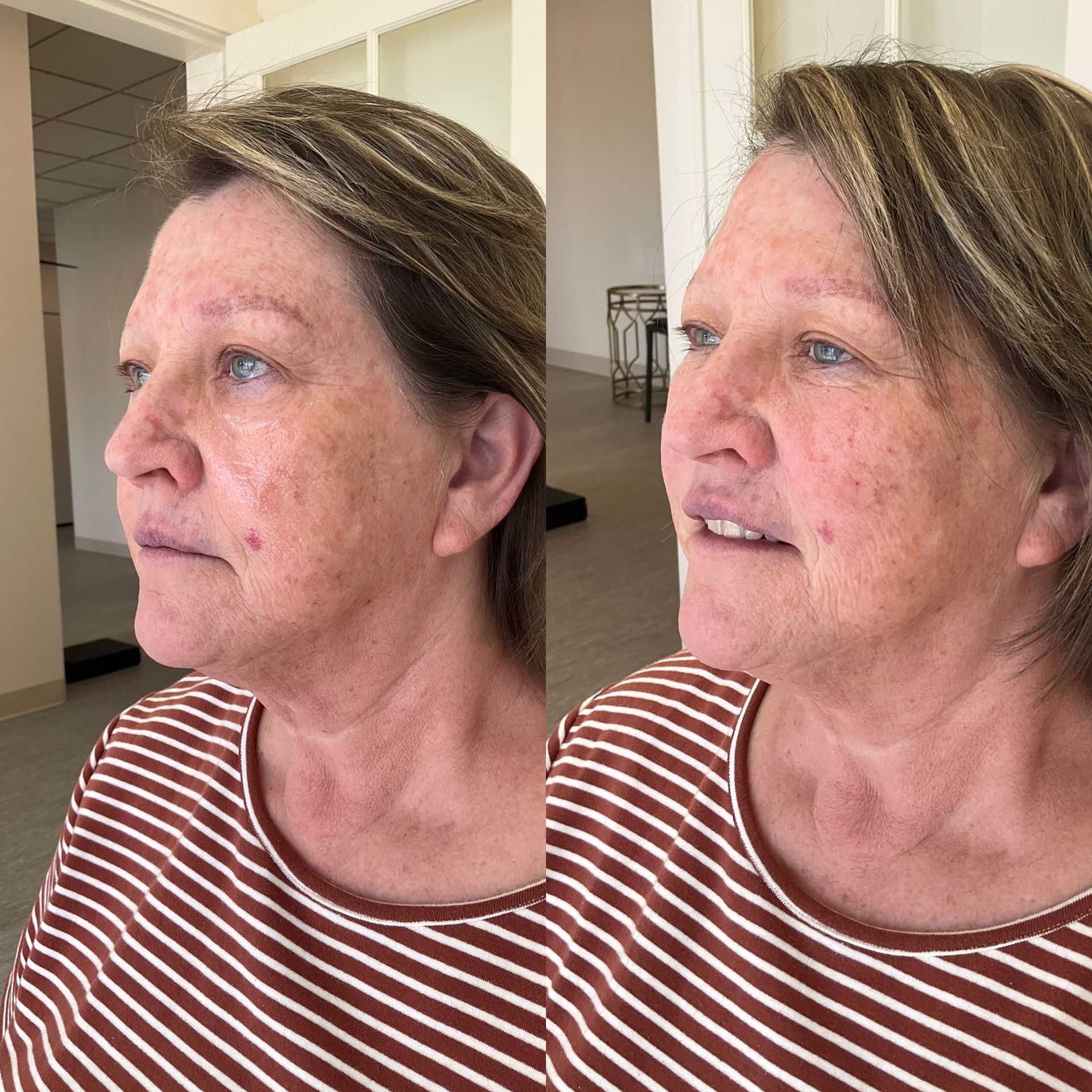 A before and after photo of a woman 's face in a striped shirt.
