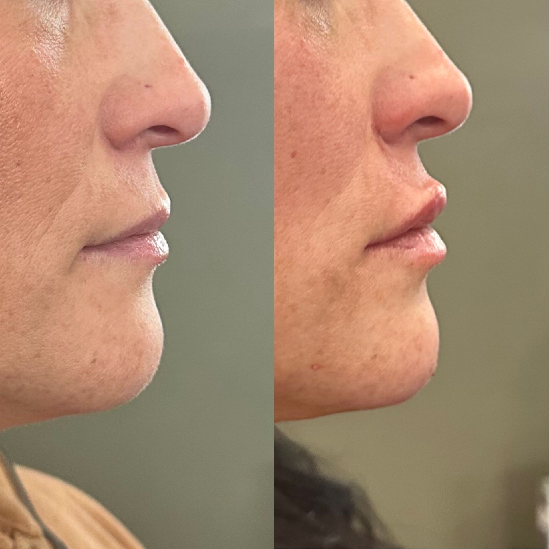 A before and after photo of a woman 's lips.
