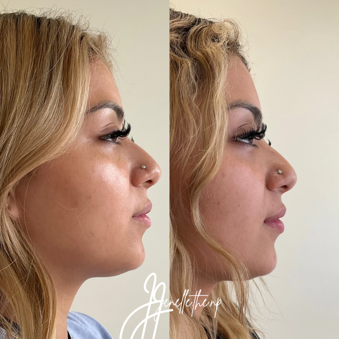 A before and after photo of a woman 's face.