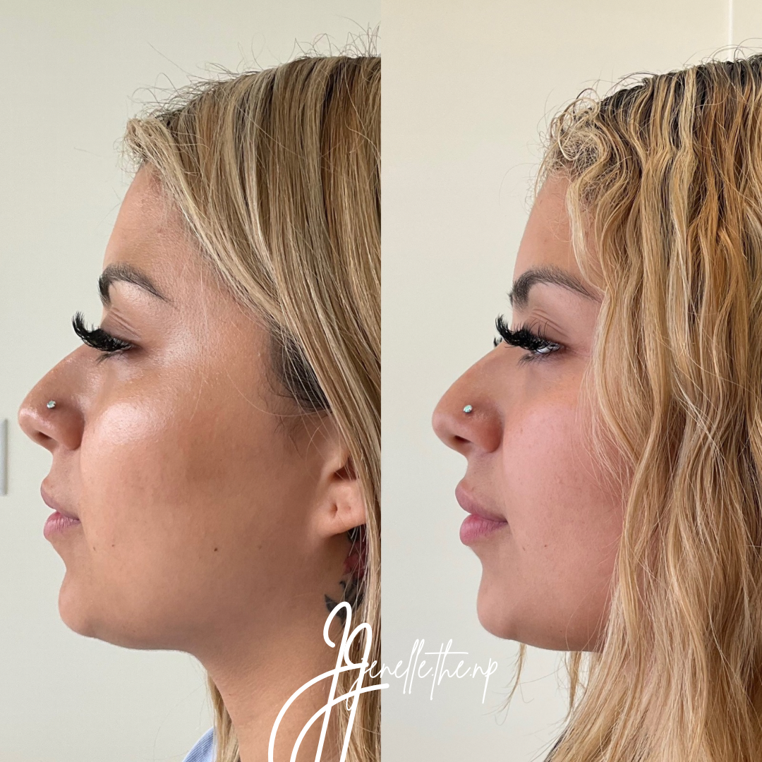 A before and after photo of a woman 's face