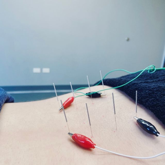 Intramuscular Electrical Stimulation for Ankle Pain, Dry needling with  intramuscular electrical stimulation for ankle pain. A lot of times, ankle  pain can be caused by other areas. In this case, tightness