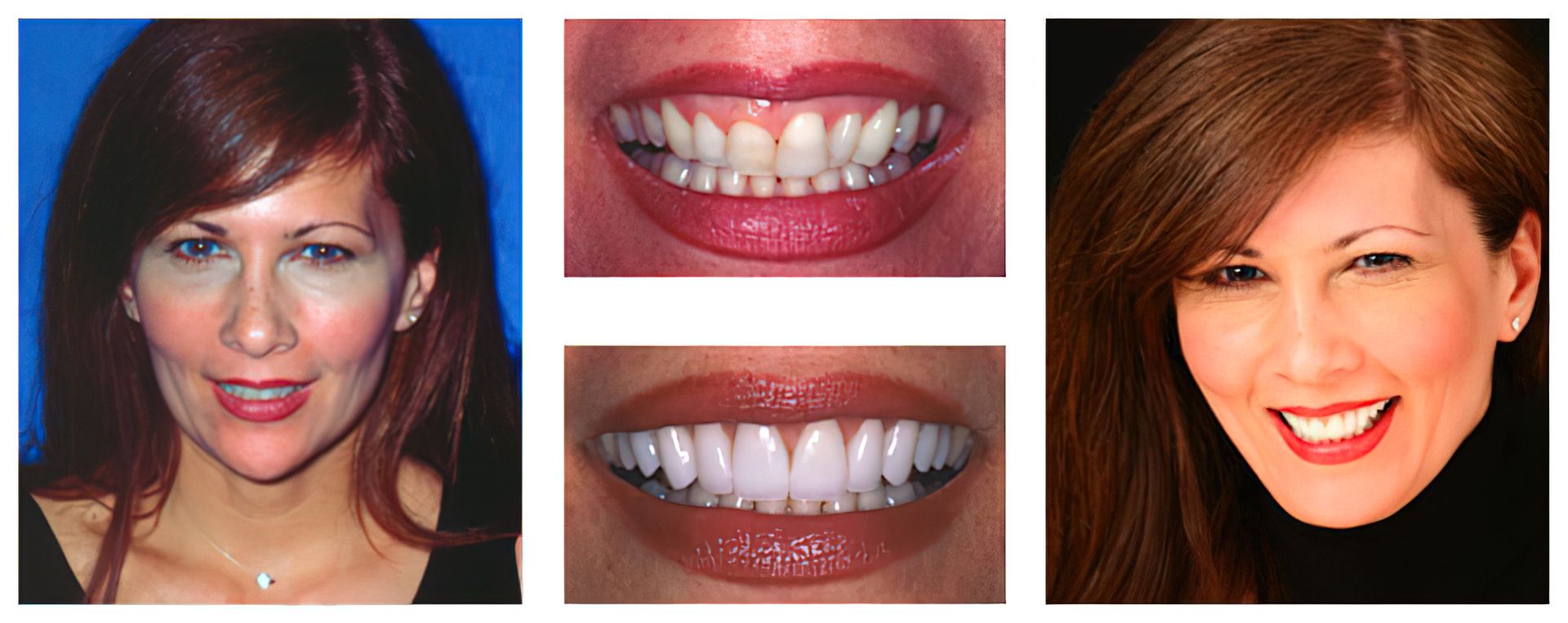 veneers before and after simpsonville sc dentist