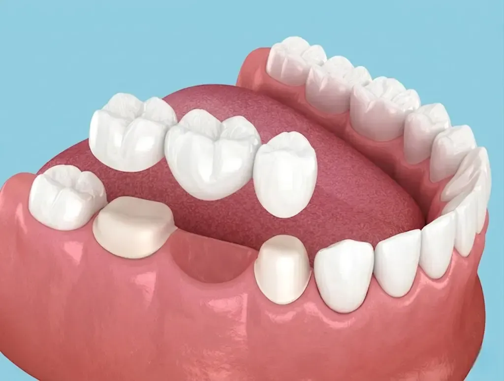 dental implants in simpsonville | upstate smiles