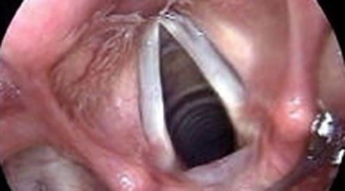 Endoscopia diagnostica per visualizzare le corde vocali negli adulti.