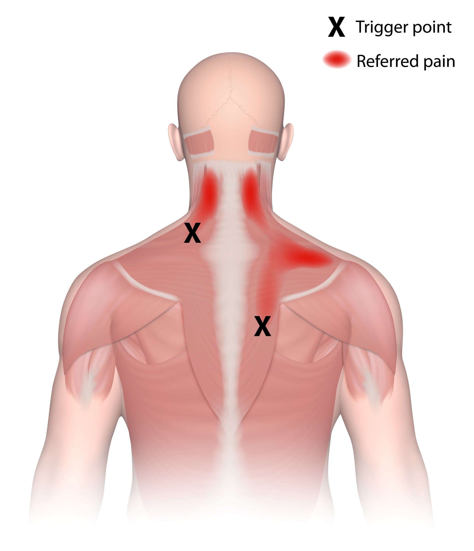 Trigger points and referred pain