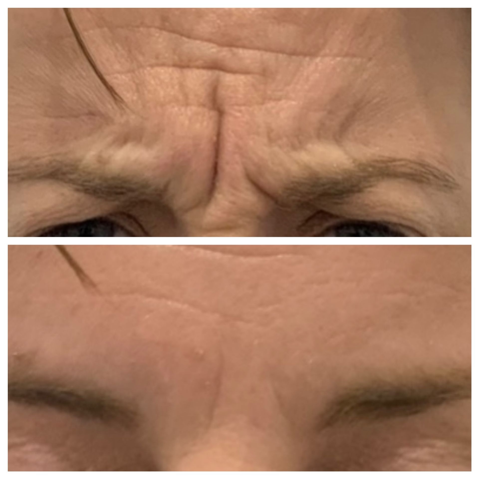 Anti-wrinkle injections - Skin Clinic in Wollongong, NSW