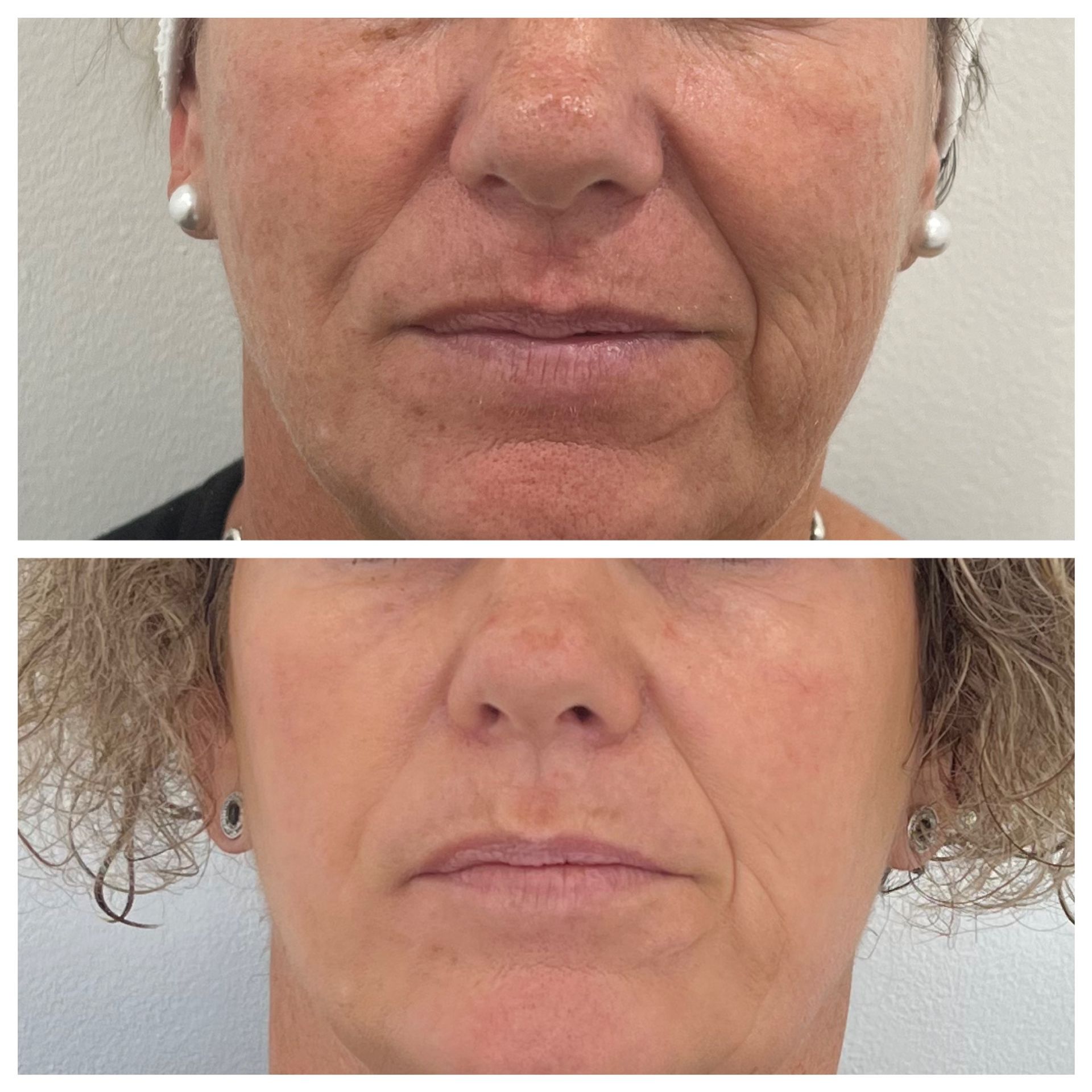 Pigmentation - Skin Clinic in Wollongong, NSW