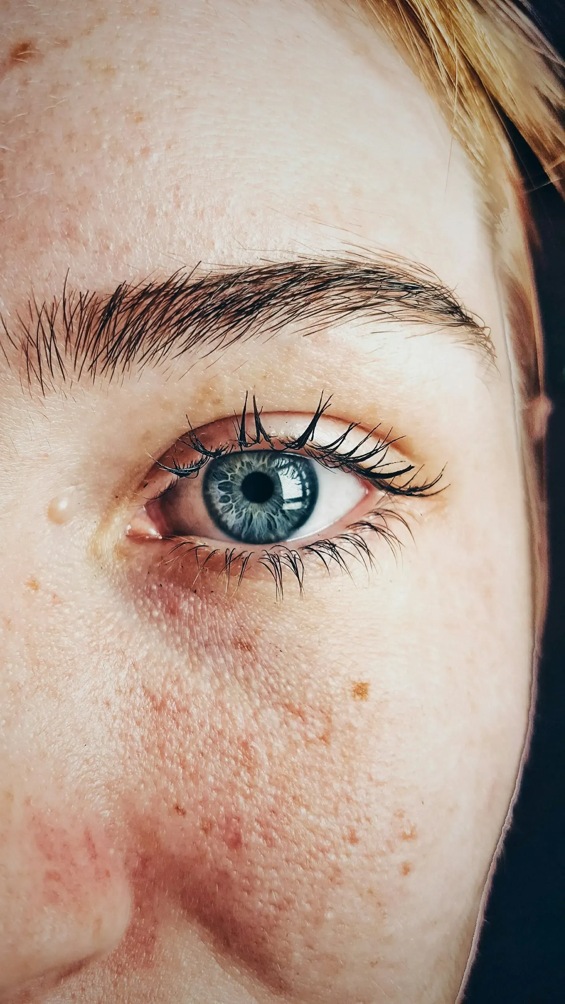 Close-up of a blue eye and freckled skin with a visible facial scar.