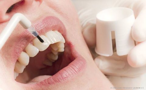 Schutz-Versiegelung der Zähne für die kieferorthopädische Behandlung