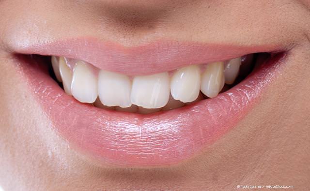 Vor der Zahnregulierung mit innenliegender fester Zahnspange