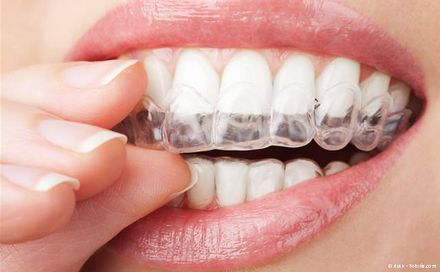 Aligner für unsichtbare Zahnregulierung