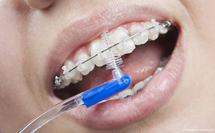 Ortho-Bürstchen für die Reinigung schwer zugänglicher Bereiche bei festen Zahnspangen
