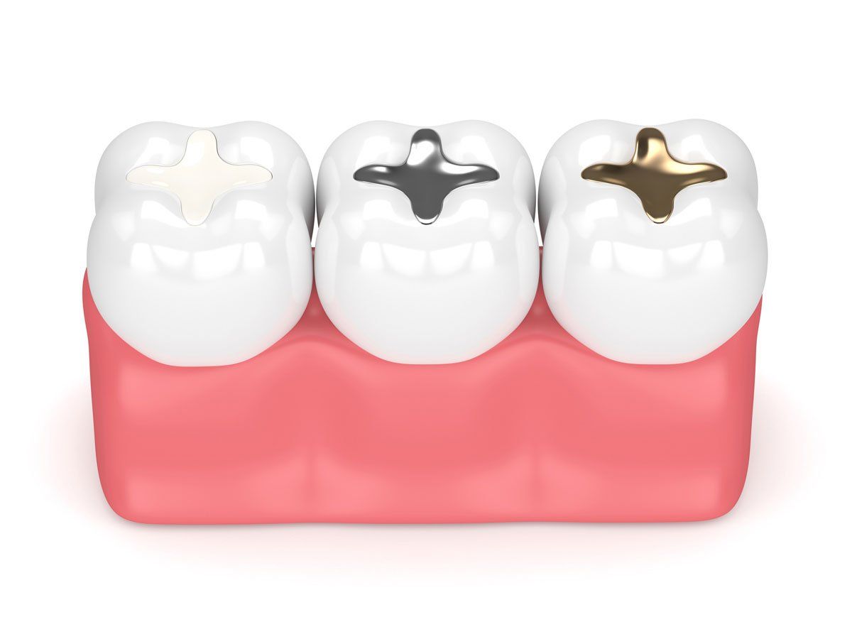 Tooth Fillings — 3D Model Of Tooth-Colored Fillings in Tukwila, WA