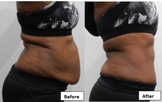 Laser-Like Lipo before and after
