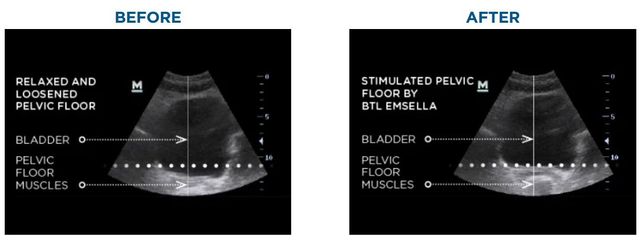 EMSELLA before and after