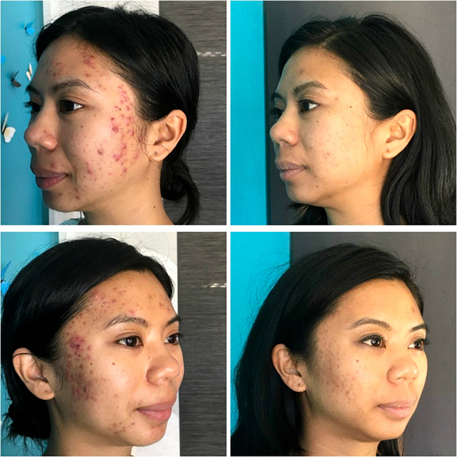 Before and after cosmetic and micro treatment