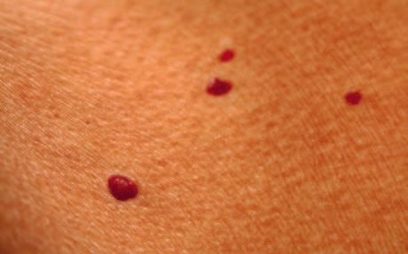 Hemangioma