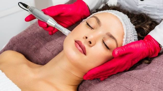 Microneedling