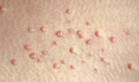 Molluscum Contagiosum