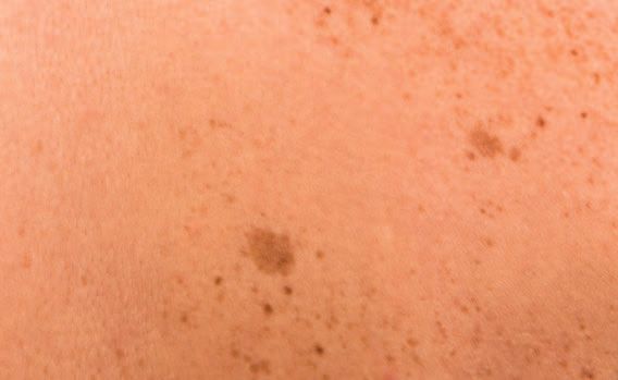 Pigmented Spot