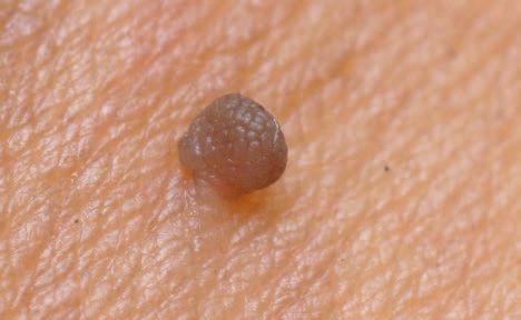 Seborrheic Keratoses