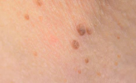 Skin Tag