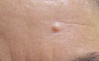 Wart