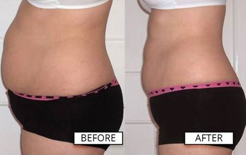 Weight-Loss-Orlando-FL-Laser-Like-Lipo-Winter-Park-Florida