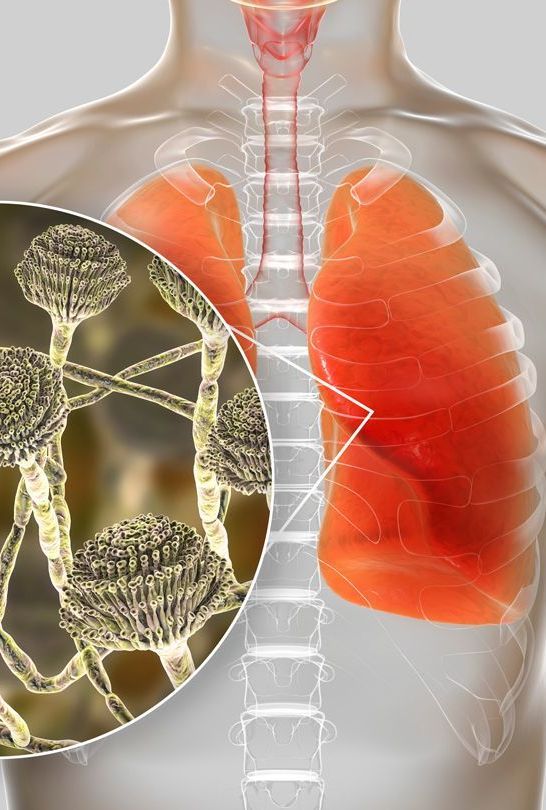 Mold sickness diagnosis and treatment