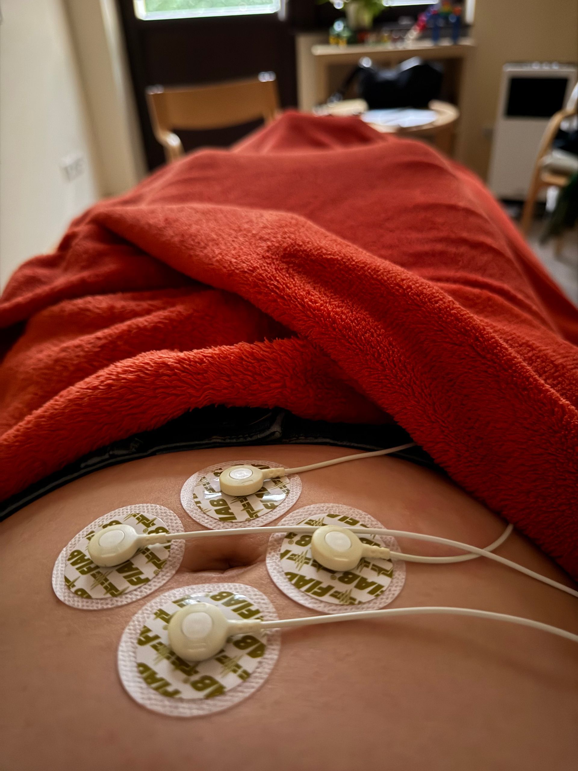 Four electrode pads attached to a person's abdomen, covered by a red blanket.