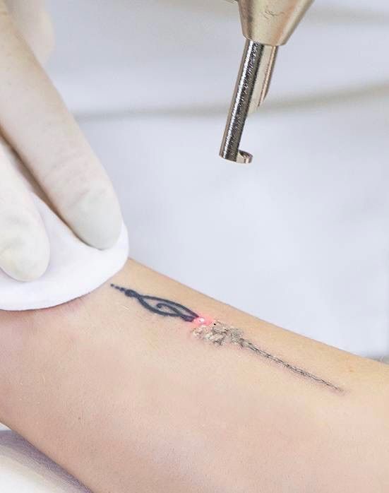 Tattoo weg laseren