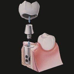 A diagram of a dental implant being placed in a tooth.