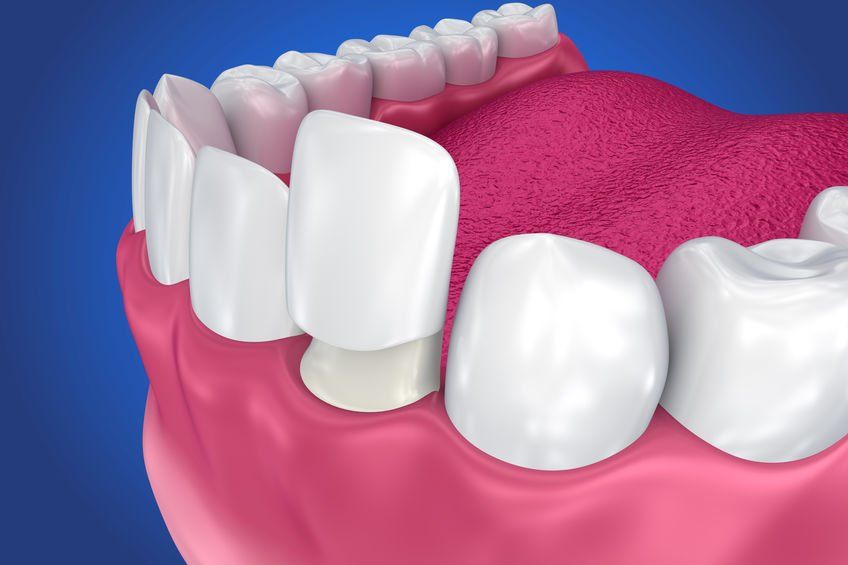 A computer generated image of a person 's teeth with porcelain veneers.
