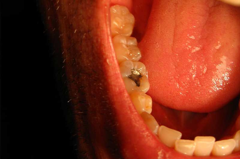 A close up of a person 's mouth with a tooth missing.