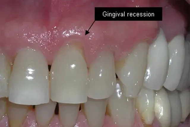 A close up of a person 's teeth with a sign that says gingival recession.