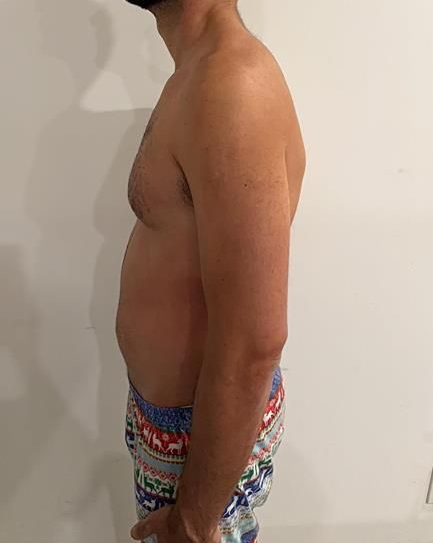 Man shirtless, standing sideways against a white wall, showing posture with a rounded upper back and abdomen.