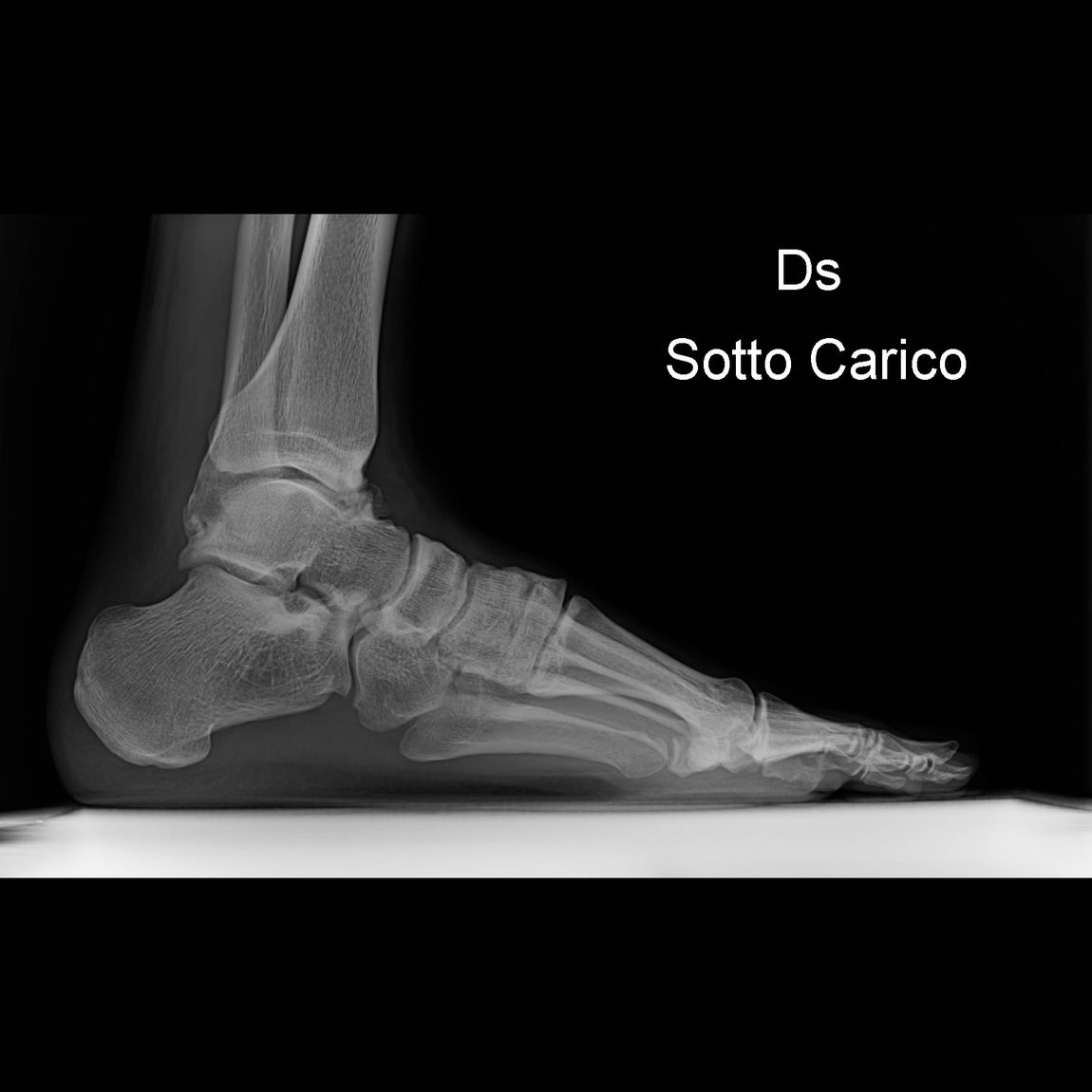 radiografia piede destro