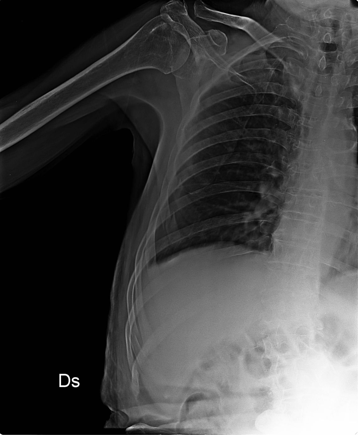radiografia polmoni