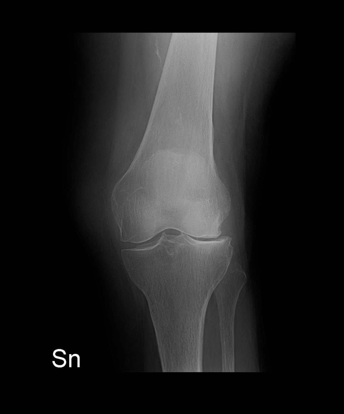 radiografia ginocchio