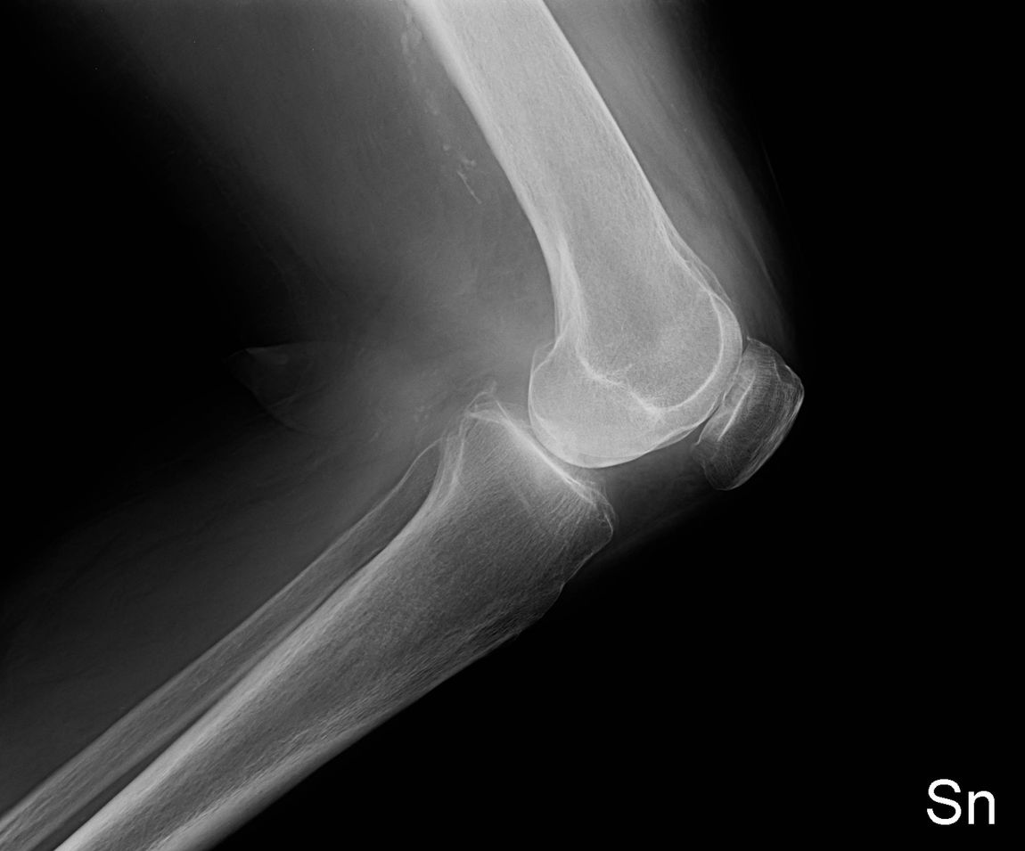 radiografia ginocchio piegato