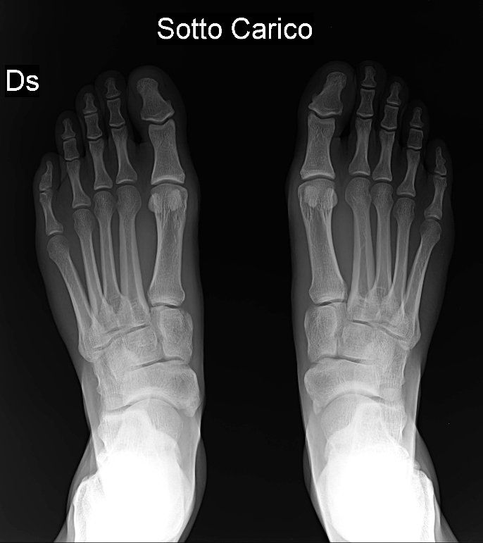 radiografia piedi