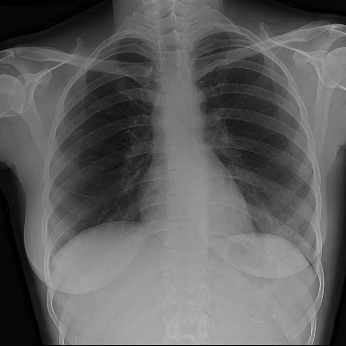 radiografia costole