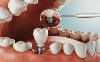 A person is getting a dental implant in their mouth.