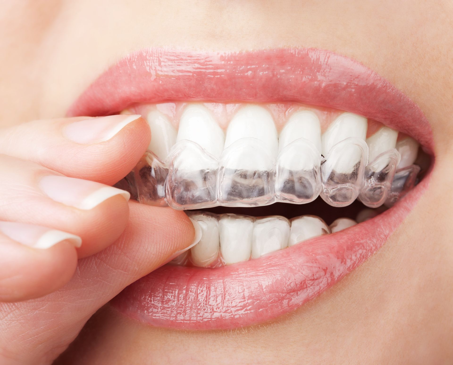 A woman is putting a clear brace on her teeth.