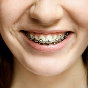 A close up of a woman 's mouth with braces on her teeth