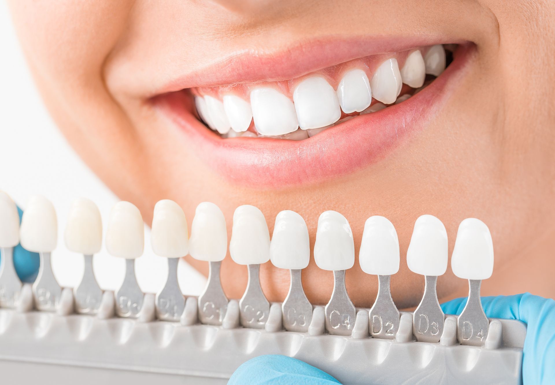 A woman is smiling while holding a tooth color chart in front of her teeth.