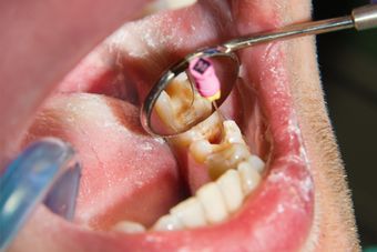 A dentist is examining a patient 's teeth with a mirror.